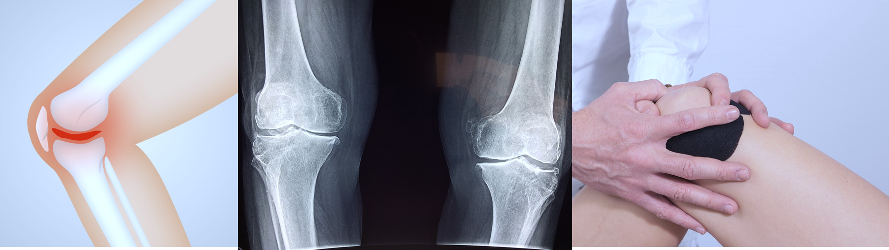 Knees-osteoarthritis